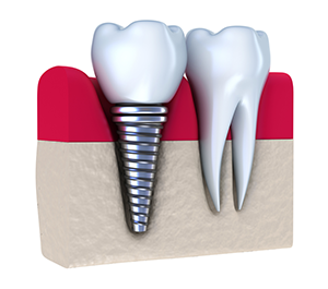 dental implants waukesha, WI